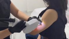 Lazer epilasyon ile istenmeyen tüylere kalıcı çözüm